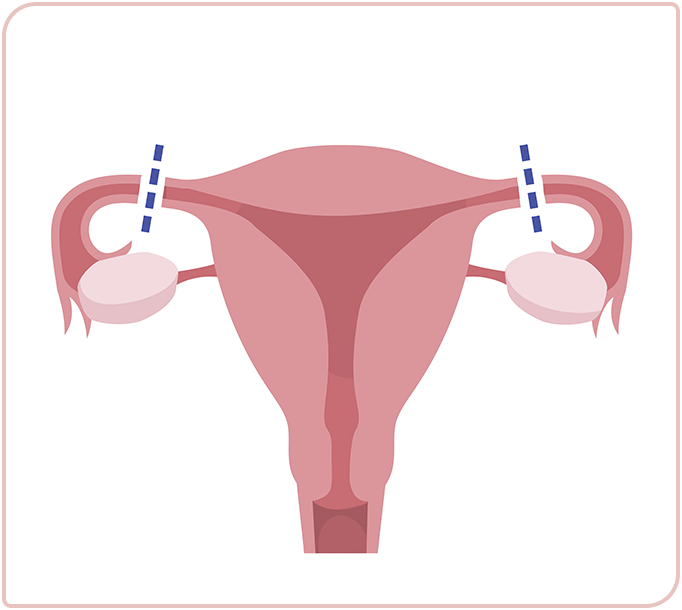 Tubal Ligation / Female Sterilisation