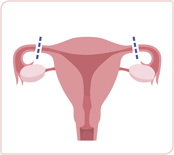 Tubal Ligation Female Sterilisation Permanent Contraception