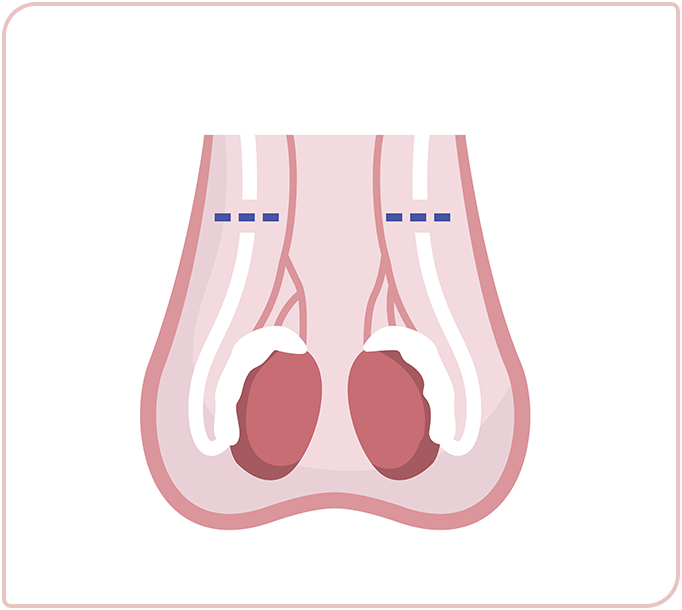 vasectomy-image