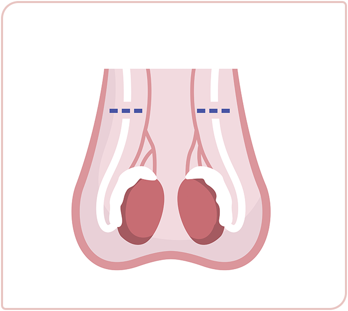 Vasektomie Sterilisation Des Mannes Informationen 